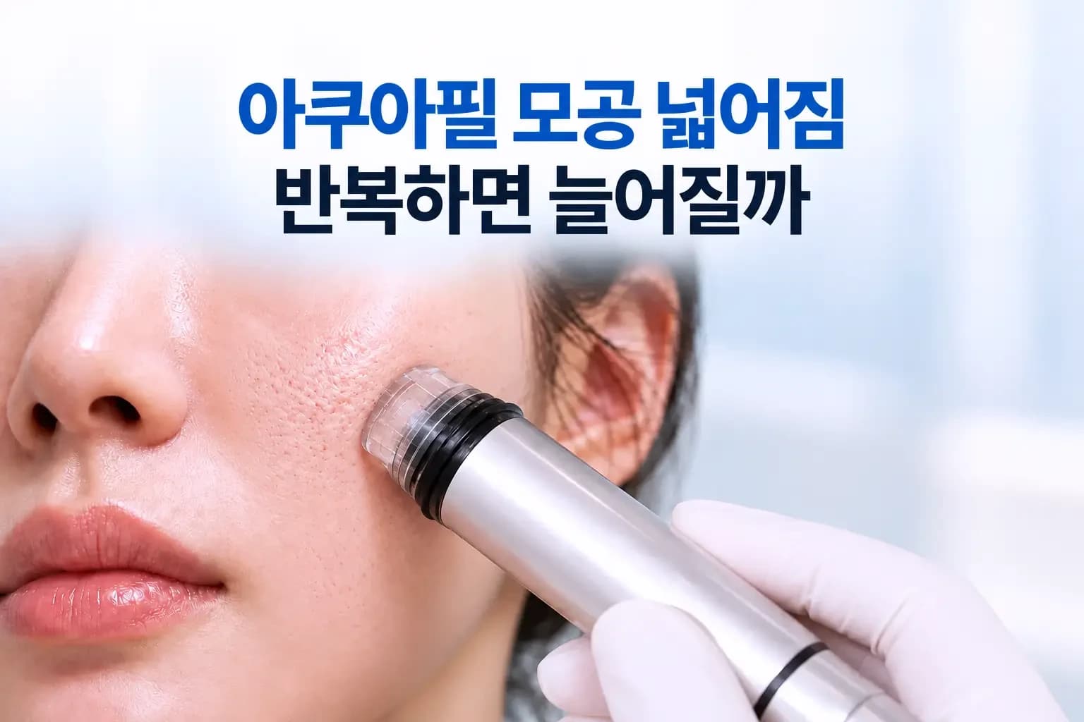 피지 마개가 빠진 모공 단면과 아쿠아필 흡입 팁을 조합한 아쿠아필 모공 넓어짐 썸네일
