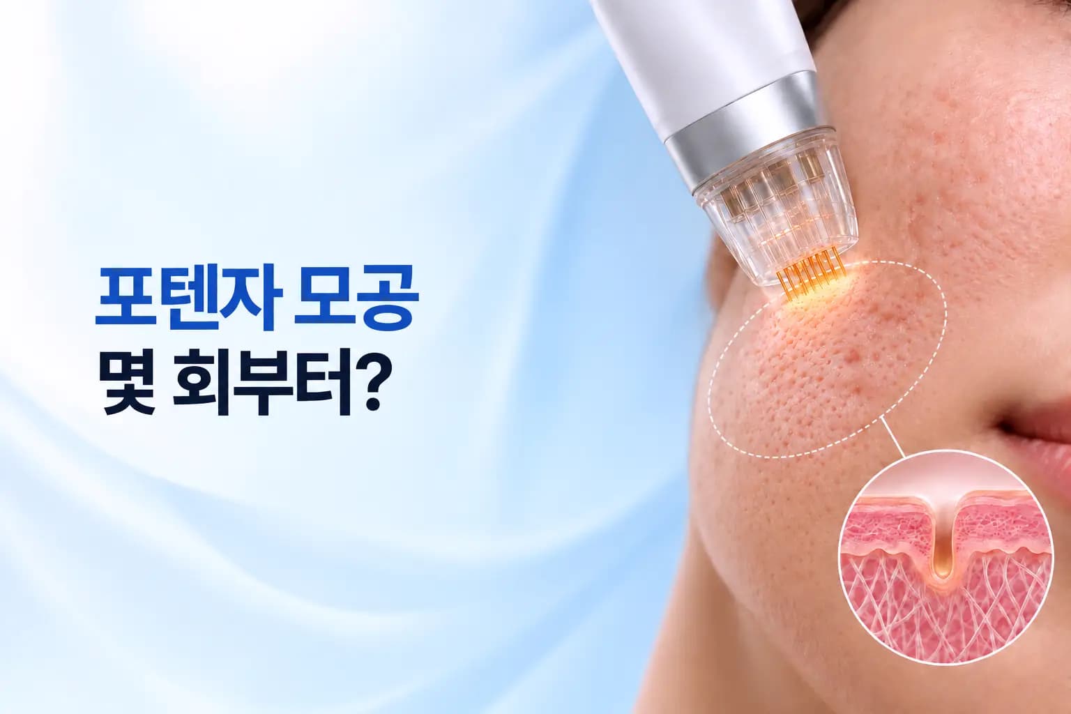 미세니들 고주파 핸드피스가 모공 피부에 닿으며 진피 콜라겐이 차오르는 회차별 변화를 담은 포텐자 모공 썸네일